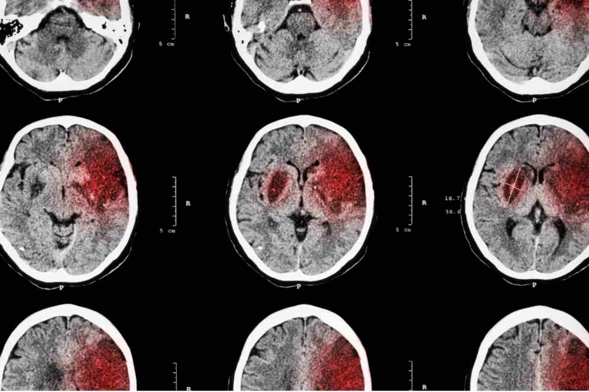 In arrivo un aiuto per chi ha sofferto di ictus