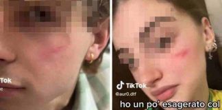 cicatrice francese trend TikTok