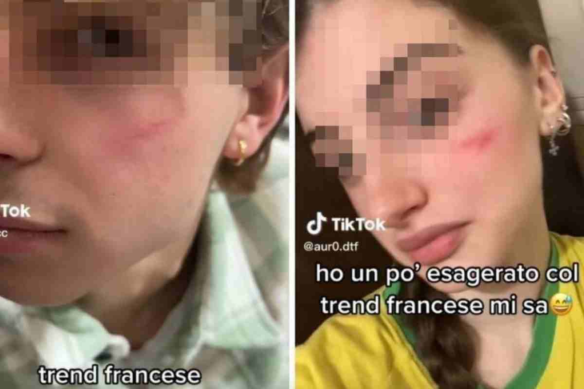 cicatrice francese trend TikTok