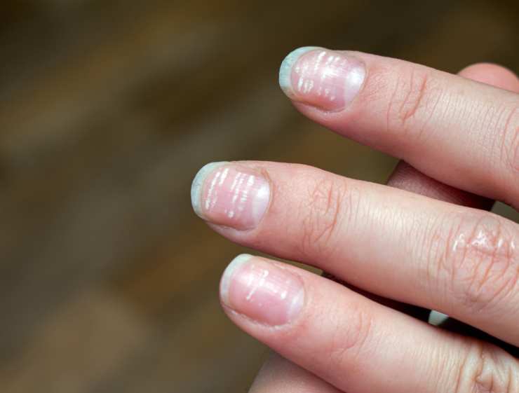 Le unghie possono indicare un problema di salute